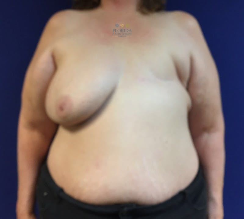 DIEP Flap Reconstruction Before & After Gallery - Patient 154952318 - Image 1