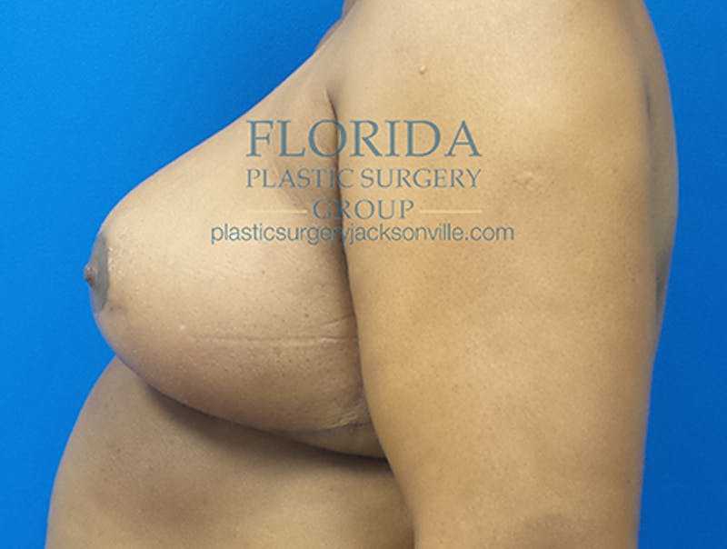 Breast Reduction Before & After Gallery - Patient 154952319 - Image 10