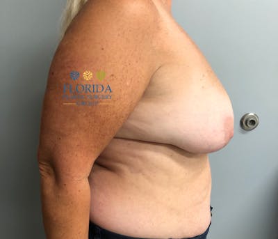 DIEP Flap Reconstruction Before & After Gallery - Patient 154952322 - Image 1