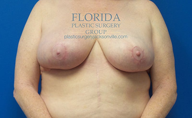 Breast Reduction Before & After Gallery - Patient 154952324 - Image 2