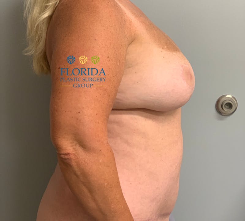 DIEP Flap Reconstruction Before & After Gallery - Patient 154952322 - Image 2