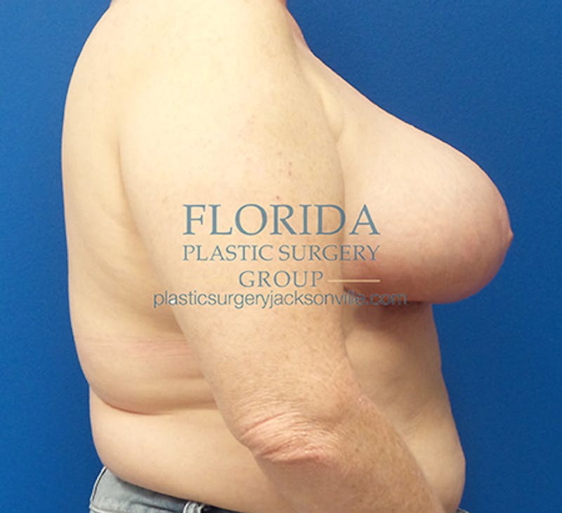 Breast Reduction Before & After Gallery - Patient 154952324 - Image 4