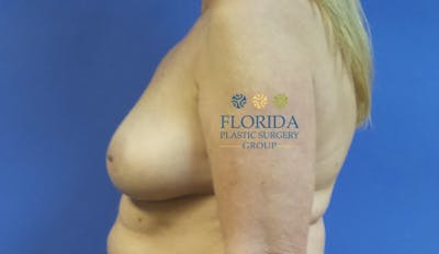 DIEP Flap Reconstruction Before & After Gallery - Patient 154952325 - Image 1