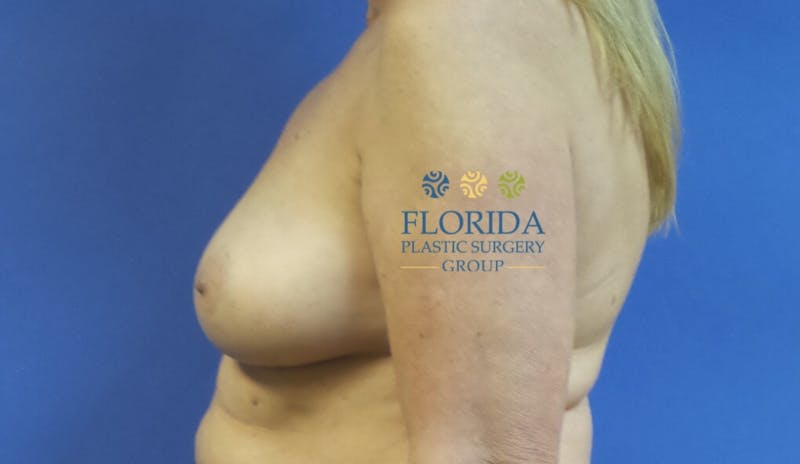 DIEP Flap Reconstruction Before & After Gallery - Patient 154952325 - Image 1