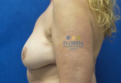 DIEP Flap Reconstruction Before & After Gallery - Patient 154952325 - Image 2