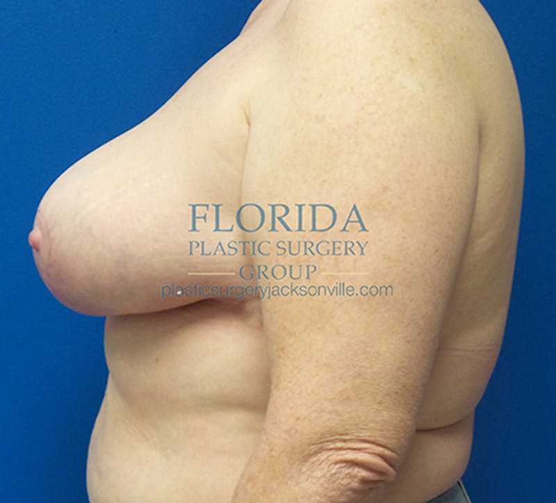 Breast Reduction Before & After Gallery - Patient 154952324 - Image 6