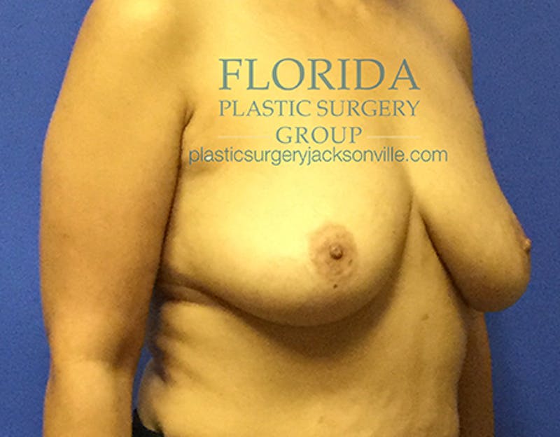 Silicone Breast Augmentation Before & After Gallery - Patient 154952331 - Image 3