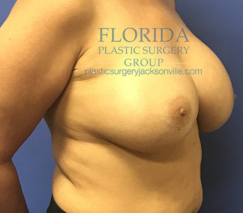 Silicone Breast Augmentation Before & After Gallery - Patient 154952331 - Image 4