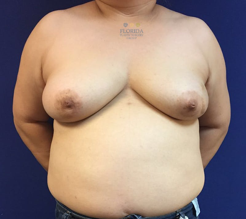 DIEP Flap Reconstruction Before & After Gallery - Patient 154952328 - Image 1