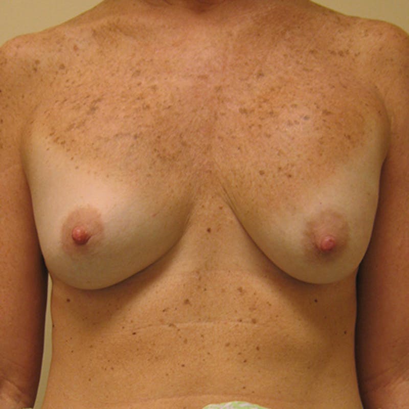 Revision Breast Surgery Before & After Gallery - Patient 154952329 - Image 1