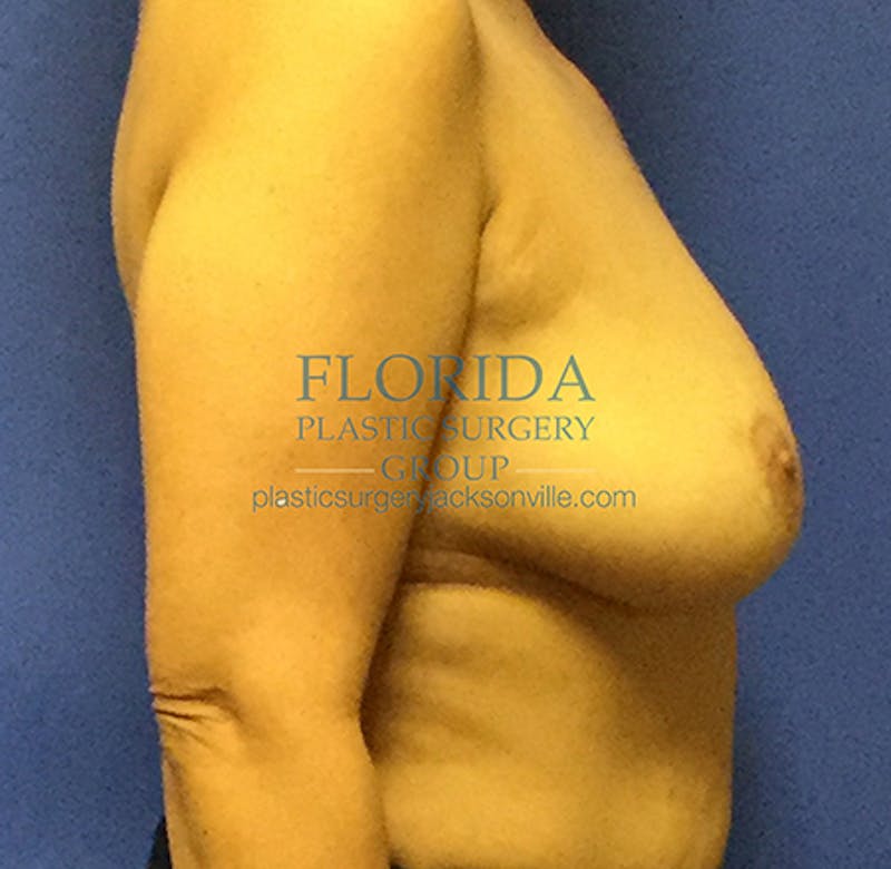 Silicone Breast Augmentation Before & After Gallery - Patient 154952331 - Image 5