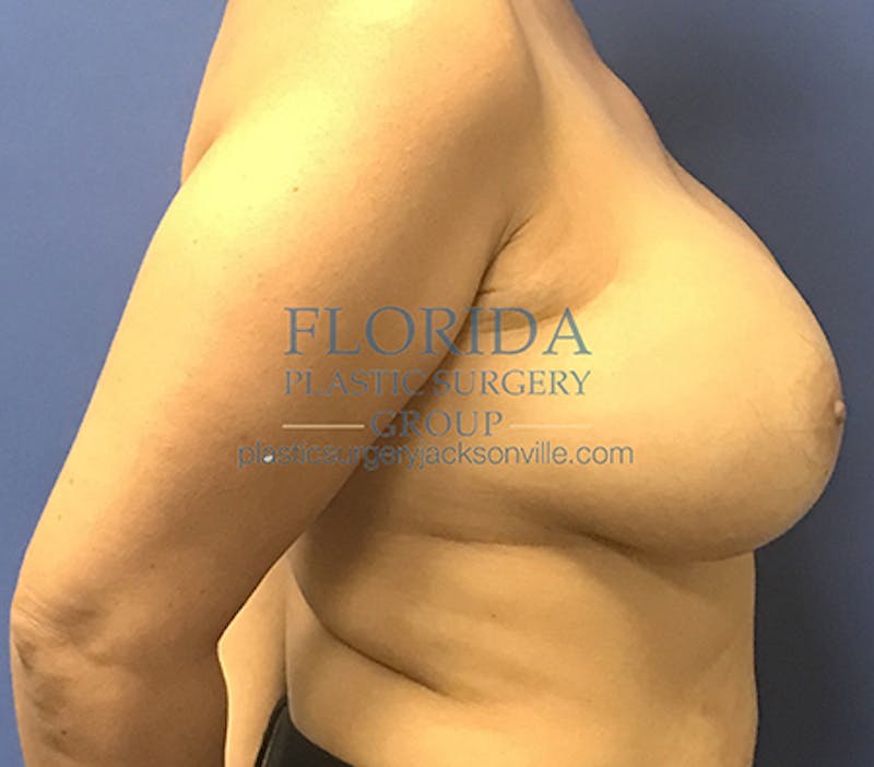 Silicone Breast Augmentation Before & After Gallery - Patient 154952331 - Image 6