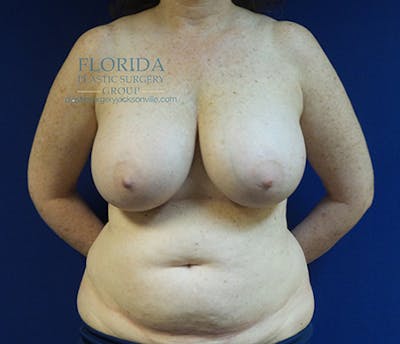 Tissue Expander Reconstruction Before & After Gallery - Patient 154952334 - Image 1