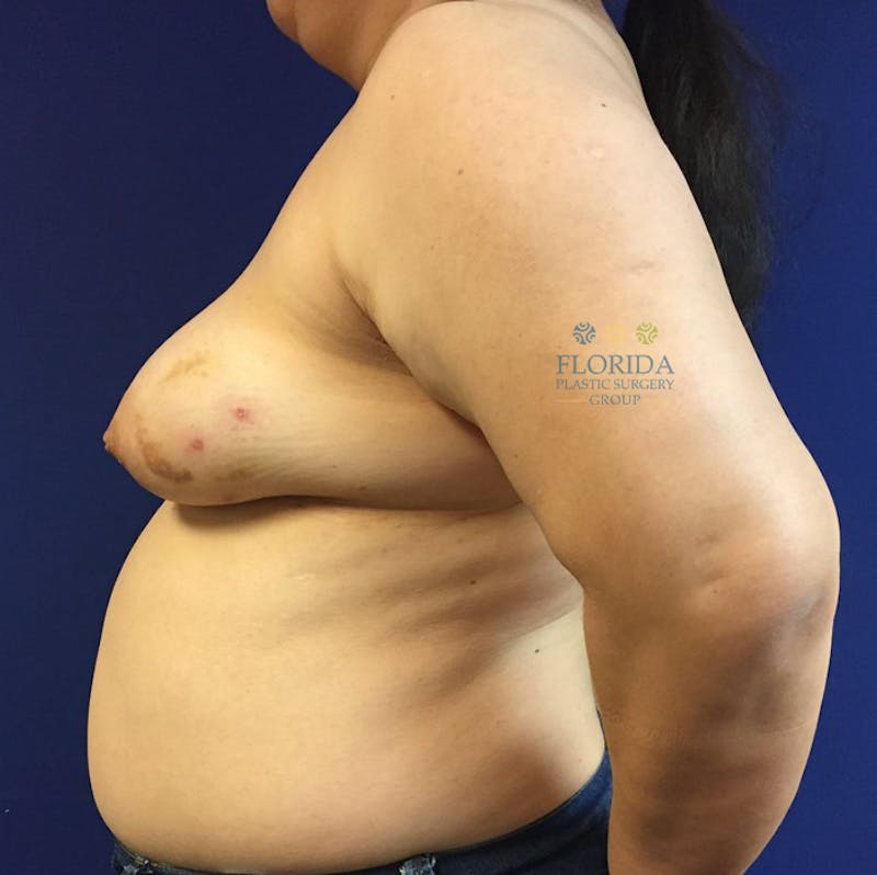 DIEP Flap Reconstruction Before & After Gallery - Patient 154952328 - Image 3