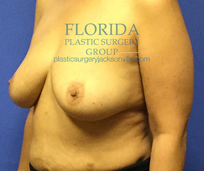 Silicone Breast Augmentation Before & After Gallery - Patient 154952331 - Image 7