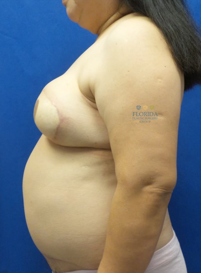 DIEP Flap Reconstruction Before & After Gallery - Patient 154952328 - Image 4