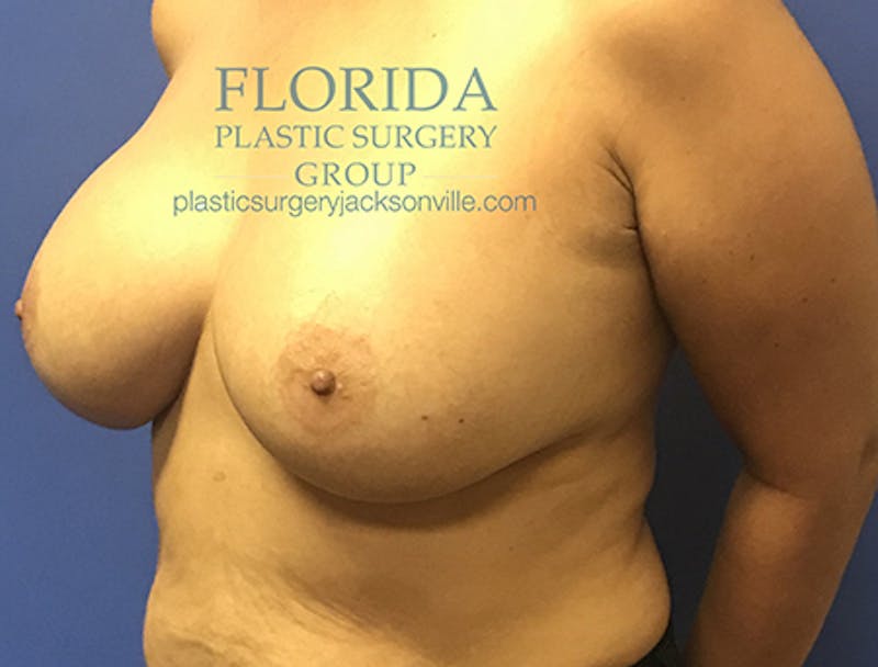 Silicone Breast Augmentation Before & After Gallery - Patient 154952331 - Image 8