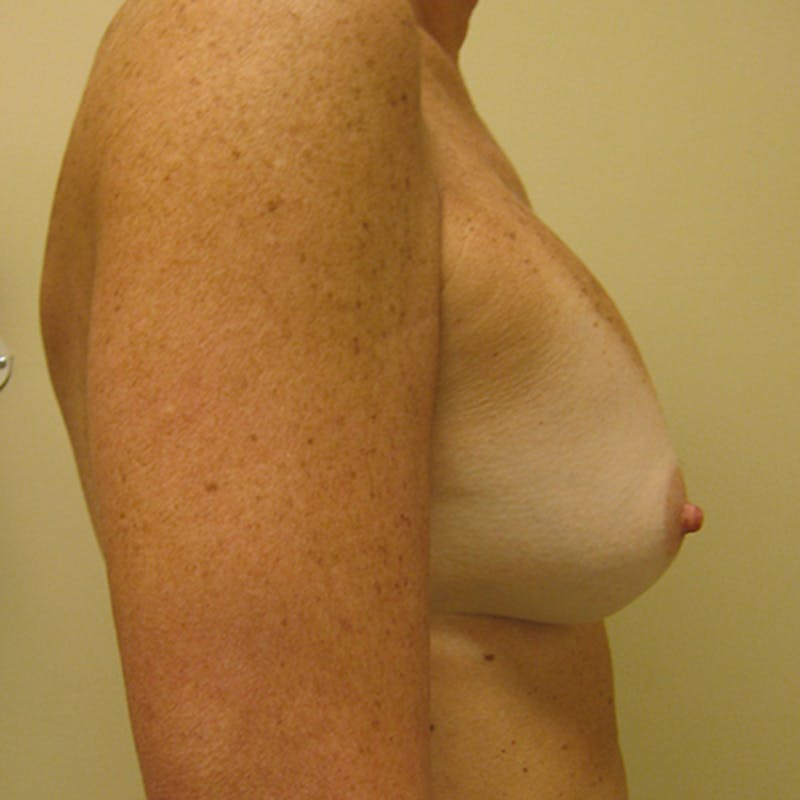 Revision Breast Surgery Before & After Gallery - Patient 154952329 - Image 5