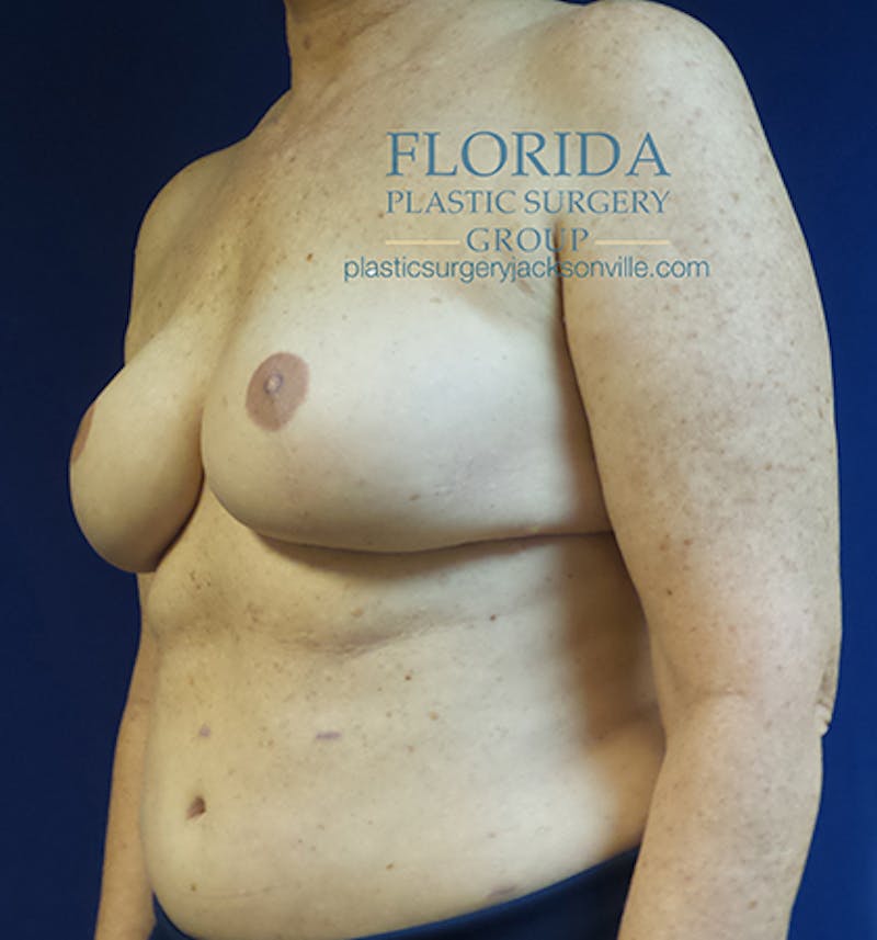 Tissue Expander Reconstruction Before & After Gallery - Patient 154952334 - Image 4
