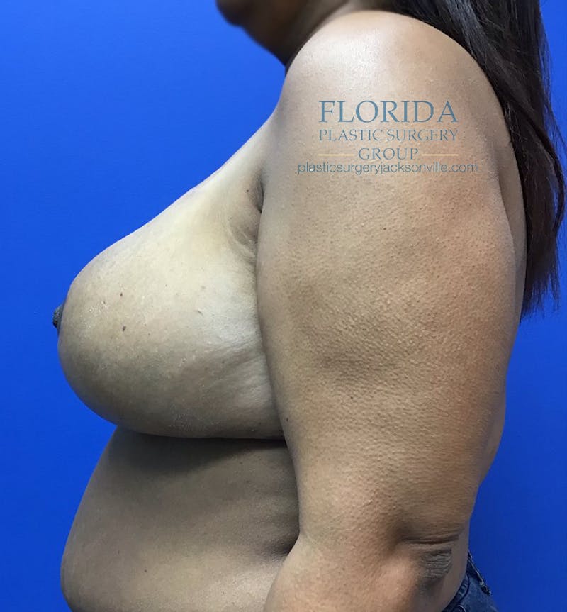Breast Reduction Before & After Gallery - Patient 154952330 - Image 6