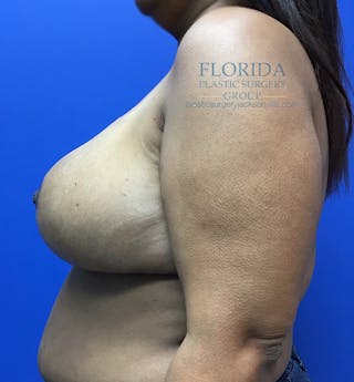 Breast Reduction Before & After Gallery - Patient 154952330 - Image 6