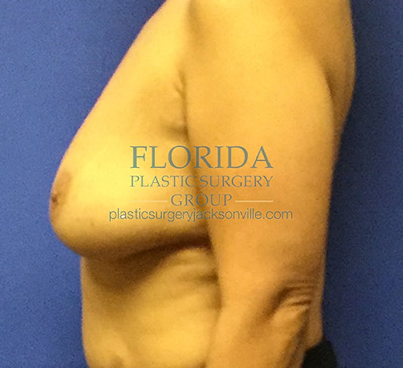Silicone Breast Augmentation Before & After Gallery - Patient 154952331 - Image 9