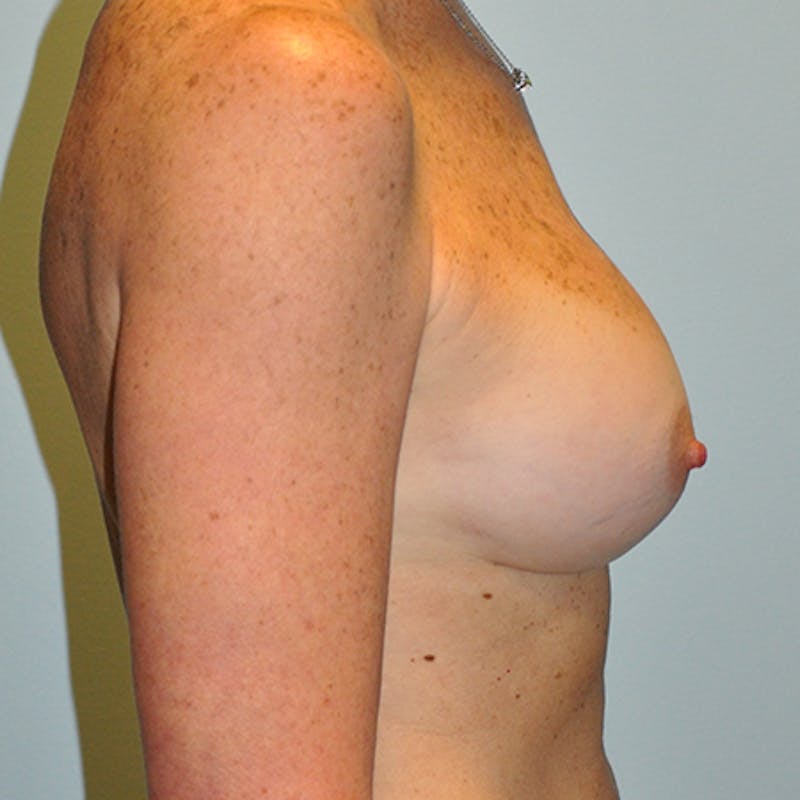 Revision Breast Surgery Before & After Gallery - Patient 154952329 - Image 6