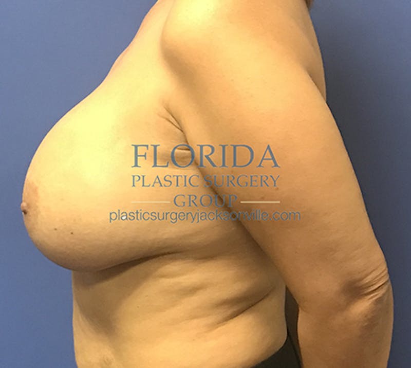 Silicone Breast Augmentation Before & After Gallery - Patient 154952331 - Image 10