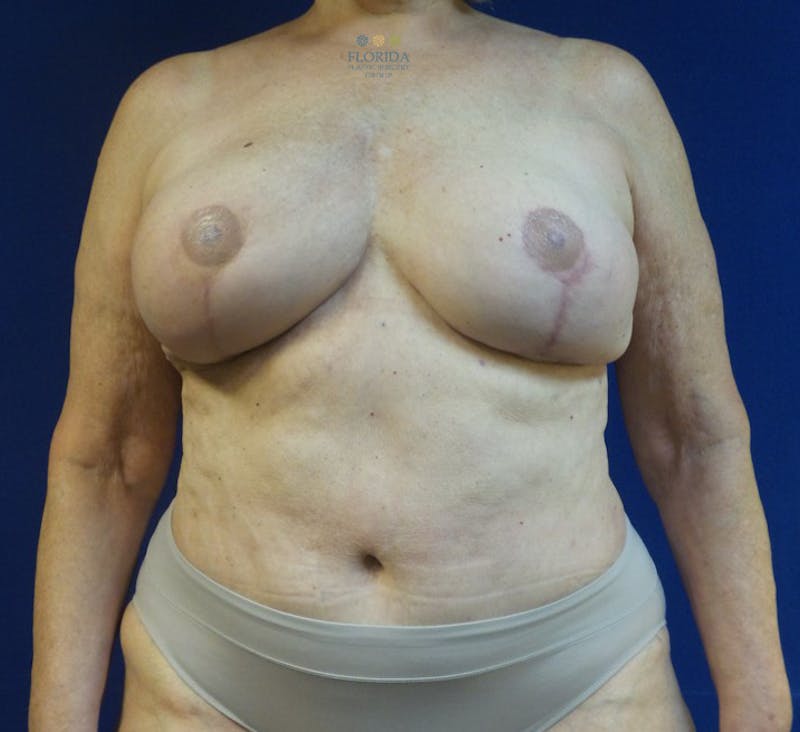DIEP Flap Reconstruction Before & After Gallery - Patient 154952332 - Image 2