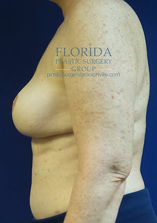 Tissue Expander Reconstruction Before & After Gallery - Patient 154952334 - Image 6