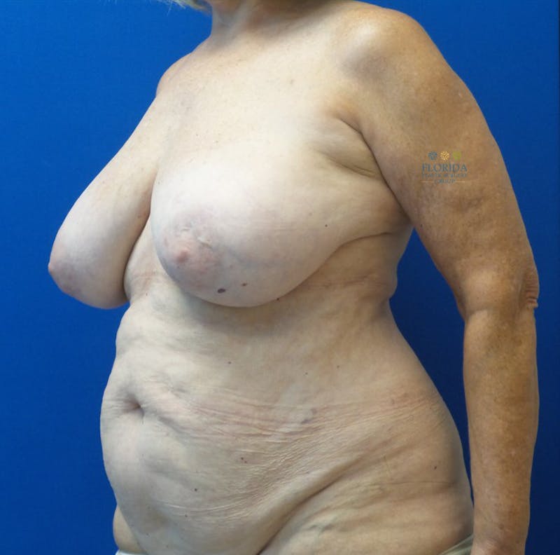 DIEP Flap Reconstruction Before & After Gallery - Patient 154952332 - Image 3