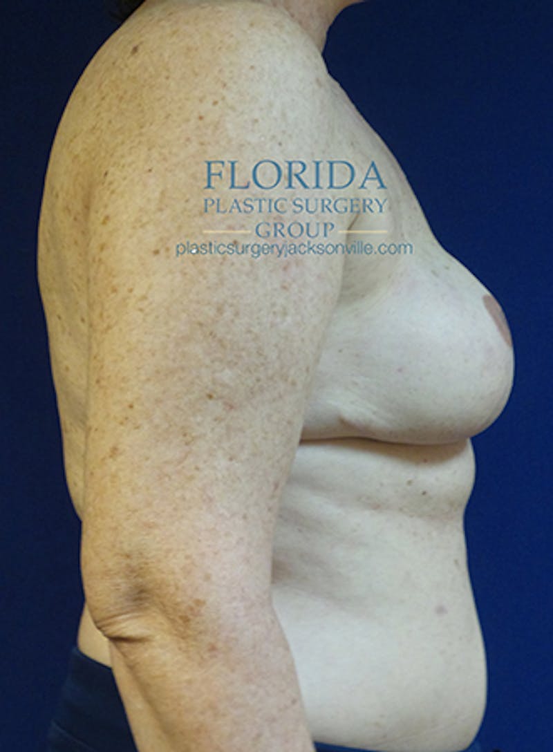 Tissue Expander Reconstruction Before & After Gallery - Patient 154952334 - Image 10