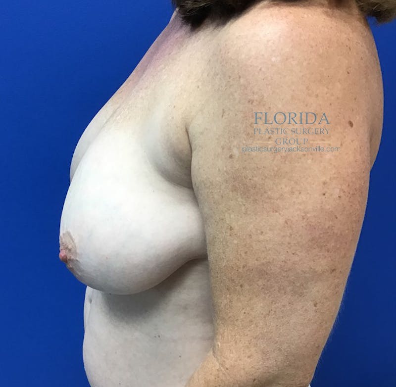 Breast Reduction Before & After Gallery - Patient 154952335 - Image 5