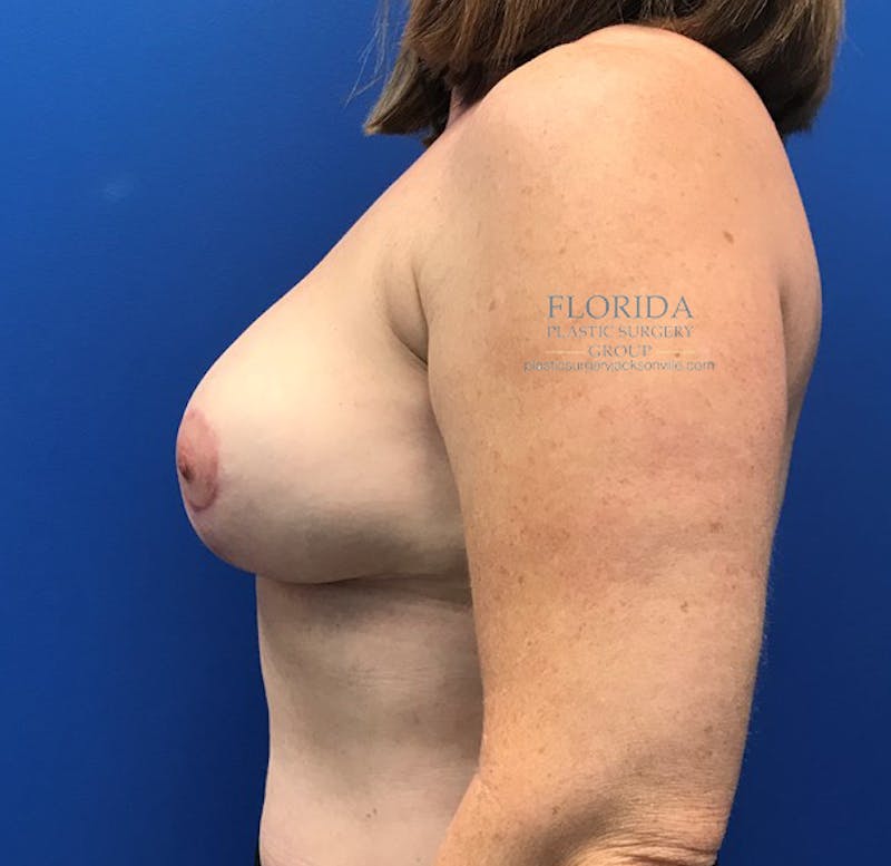 Breast Reduction Before & After Gallery - Patient 154952335 - Image 6