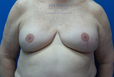 Tissue Expander Reconstruction Before & After Gallery - Patient 154952339 - Image 2