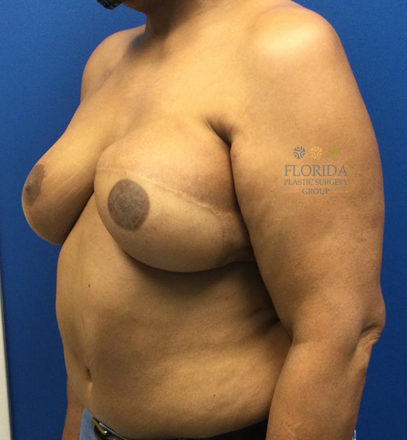 DIEP Flap Reconstruction Before & After Gallery - Patient 154952338 - Image 4