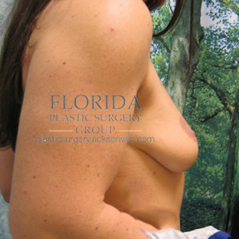 Revision Breast Surgery Before & After Gallery - Patient 154952337 - Image 5
