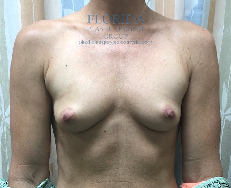 Silicone Breast Augmentation Before & After Gallery - Patient 154952345 - Image 1