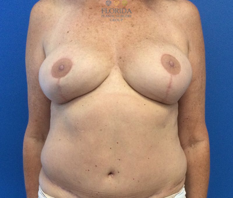 DIEP Flap Reconstruction Before & After Gallery - Patient 154952342 - Image 2