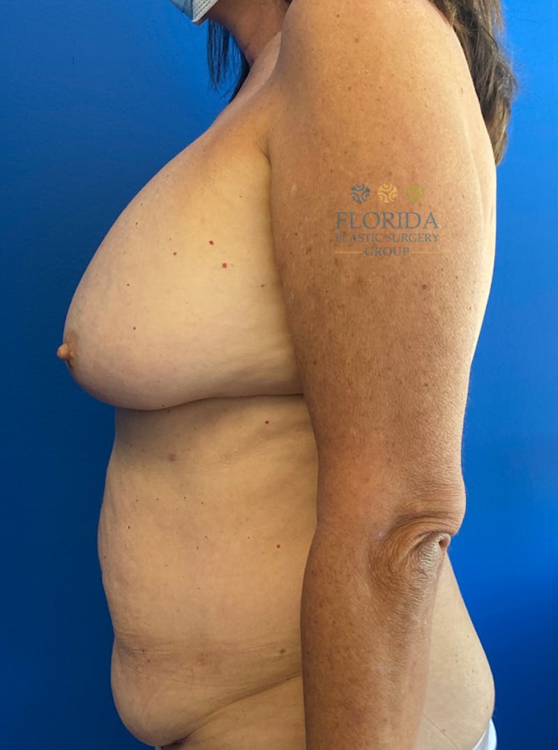 DIEP Flap Reconstruction Before & After Gallery - Patient 154952342 - Image 3