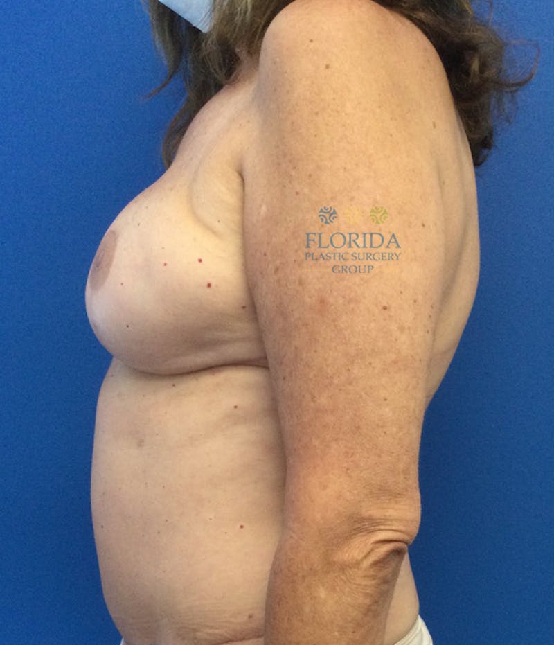 DIEP Flap Reconstruction Before & After Gallery - Patient 154952342 - Image 4