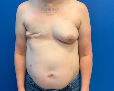 DIEP Flap Reconstruction Before & After Gallery - Patient 154993549 - Image 1