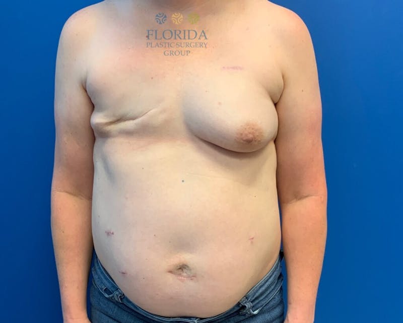 DIEP Flap Reconstruction Before & After Gallery - Patient 154993549 - Image 1