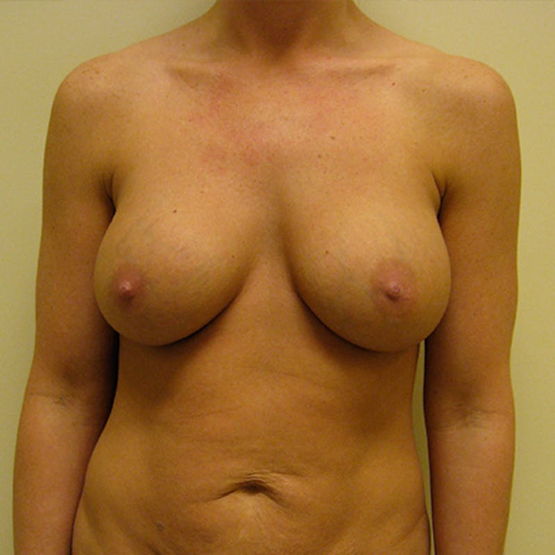Revision Breast Surgery Before & After Gallery - Patient 154980348 - Image 1