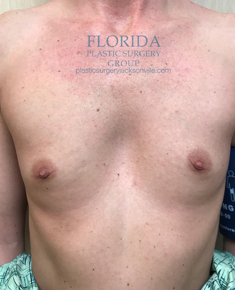 Silicone Breast Augmentation Before & After Gallery - Patient 154991349 - Image 1
