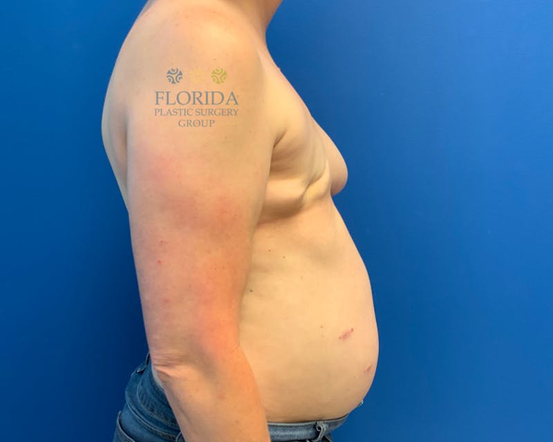 DIEP Flap Reconstruction Before & After Gallery - Patient 154993549 - Image 3