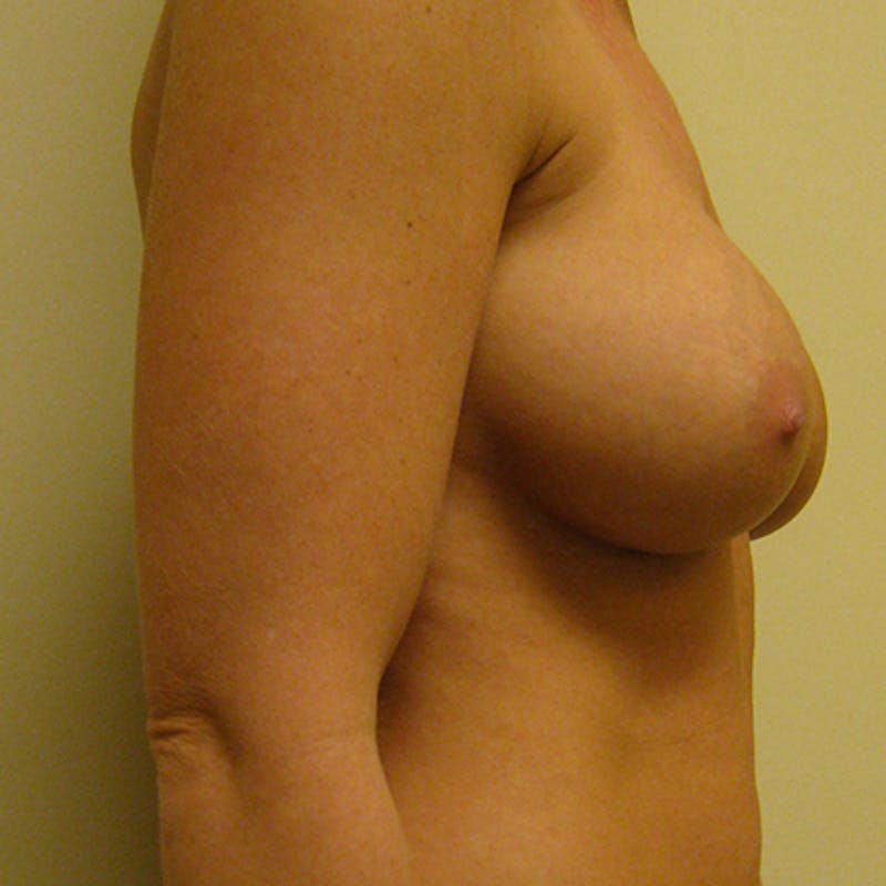 Revision Breast Surgery Before & After Gallery - Patient 154980348 - Image 3