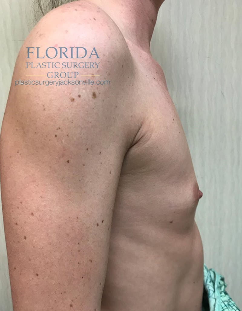 Silicone Breast Augmentation Before & After Gallery - Patient 154991349 - Image 3