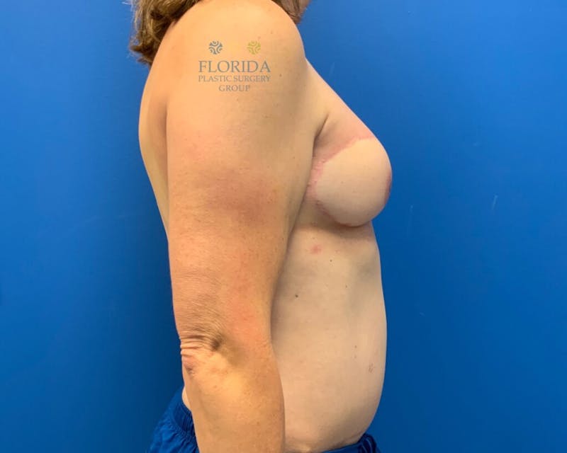 DIEP Flap Reconstruction Before & After Gallery - Patient 154993549 - Image 4