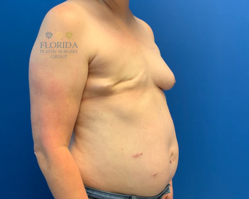 DIEP Flap Reconstruction Before & After Gallery - Patient 154993549 - Image 5